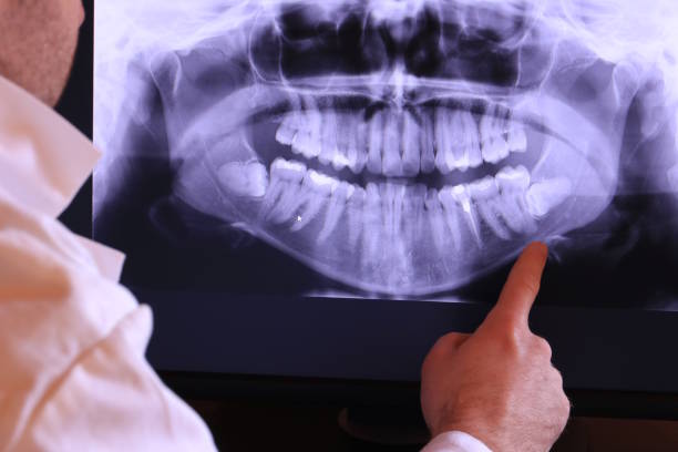 Best Emergency Wisdom Teeth Removal in Surrey, ND